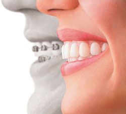 Invisalign versus braces