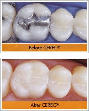 Before and After Picture of Teeth 