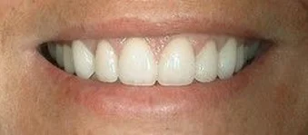 Close-up of an improved smile with aligned, natural-looking front teeth after dental treatment.