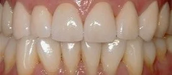 Close-up of upper and lower front teeth showing the results after dental treatment.