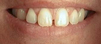 Close-up of upper front teeth before dental treatment.