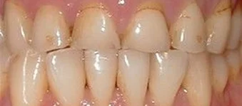 Close-up of upper and lower front teeth before dental treatment.