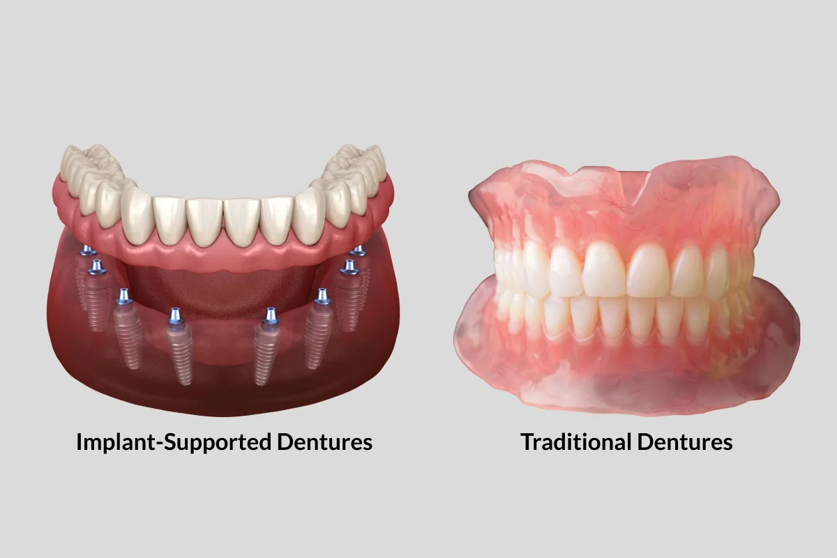 Dental Implants vs. Dentures